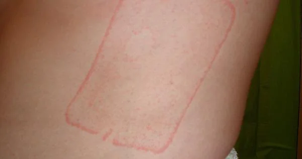an example of a defibrillator burn to the skin
